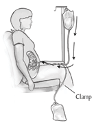 The final step of the exchange is to refill the peritoneal cavity with fresh dialysis solution from the hanging bag.