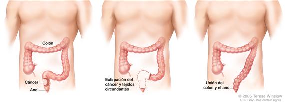 La ilustración a tres paneles muestra cirugía de cáncer del recto con anastomosis; el primer panel muestra el área del recto con cáncer, el panel medio muestra la extracción del cáncer y el tejido circundante, el último panel muestra la unión del colon y el ano.