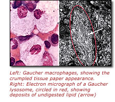 Left: Gaucher macrophages, showing the crumpled tissue paper appearance. Right: Electron micrograph of a Gaucher lysosome showing deposits of undigested lipid