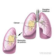 Neumonectomía; el dibujo muestra la tráquea, ganglios linfáticos y los pulmones con cáncer en un pulmón. Se muestra el pulmón con cáncer que se extrajo.