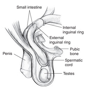 Drawing of an inguinal hernia with the small intestine, internal inguinal ring, external inguinal ring, pubic bone, penis, spermatic cord, and testes labeled.