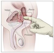 Examen rectal digital; el dibujo muestra una vista lateral de la anatomía reproductora y urinaria masculina la cual incluye la próstata, el recto y la vejiga; también muestra un dedo dentro de un guante lubricado que se inserta en el recto para palpar la próstata.