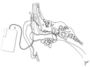 an illustration of a cochlear implant