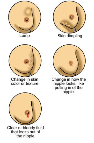 Changes to look for in the breast illustration