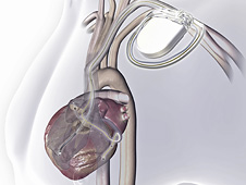 Artist depiction of the placement of a Medtronic Inc. Attain Ability left-heart lead