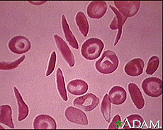 Photomicrograph of red blood cells, including multiple sickle cells