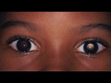 Anisometropia is a condition in which the eyes have unequal refractive power.