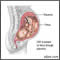 Congenital cytomagalovirus