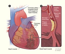 heart attacks diagram
