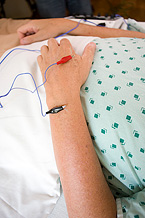 Electroacupuncture needles in arm