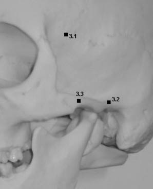 Representation of landmarks on the temporal bone:temporal fossa, root of zygoma, zygion.