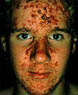 Severe nodular acne