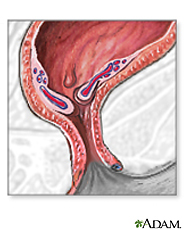 Ilustración de las hemorroides inflamadas