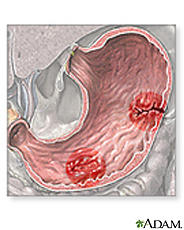 Ilustración de úlceras estomacales