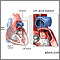 Left atrial myxoma