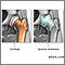 Osteoartritis contra artritis reumatoide