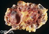 specimen of a polycystic human kidney