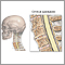 Espondilosis cervical