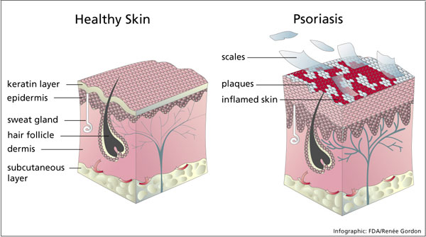 illustration of healthy skin and skin with psoriasis