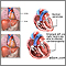 Cardiomiopatía alcohólica