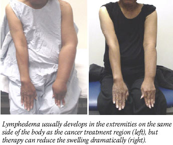 Image showing lymphedema reduction in the extremities