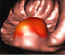 Virtual colonoscopy image of the inside of a colon. The red colored area indicates a polyp. Image courtesy of Dr. Ronald M. Summers, Diagnostic Radiology Department, Clinical Center, National Institutes of Health.