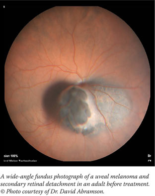 A wide-angle fundus photograph of a uveal melanoma and secondary retinal detachment in an adult before treatment. © Photo courtesy of Dr. David Abramson.