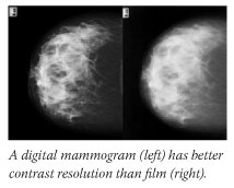 A digital mammogram (left) has better contrast resolution than film (right).