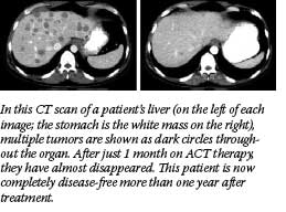In this CT scan of a patient's liver (on the left of each image; the stomach is the white mass on the right), multiple tumors are shown as dark circles throughout the organ. After just 1 month on ACT therapy, they have almost disappeared. This patient is now completely disease-free more than one year after treatment.