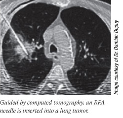 Guided by computed tomography, an RFA needle is inserted into a lung tumor. Image courtesy of Dr. Damian Dupuy