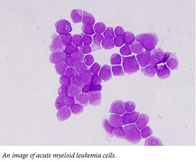 An image of acute myeloid leukemia cells.