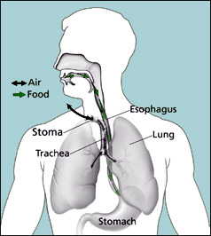 Illustration shows the pathways for air
and food after a total laryngectomy.