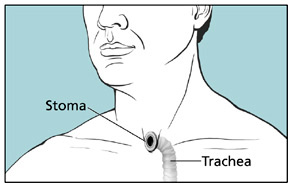 Illustration shows a stoma.