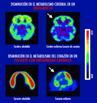 Brain and heart metabolism image