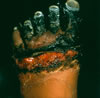 6. Wet gangrenous change, thawed at room temperature (26 days post injury).