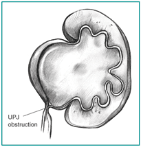 Diagram illustrating ureteropelvic junction (UPJ) obstruction.  The point where the kidney joins the ureter is blocked.  As a result, the kidney swells.