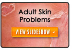 Adult Skin Problems Slideshow