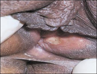 Plate 12: Chancroid. A picture of the vaginal opening clearly showing an open, white, ulcerous sore on the inside of one of the vaginal lips.