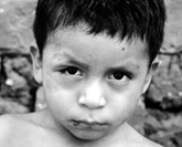 This child from Panama is suffering from Chagas’ disease manifested as an acute infection with swelling of the right eye