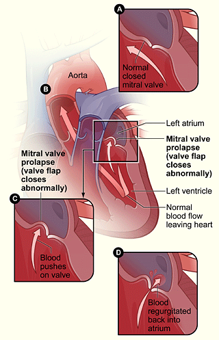 Figure A shows a normal mitral valve that separates the left atrium from the left ventricle. Figure B shows a heart with mitral valve prolapse. Figure C shows the detail of mitral valve prolapse. Figure D shows a mitral valve that allows blood to flow backward into the left atrium.