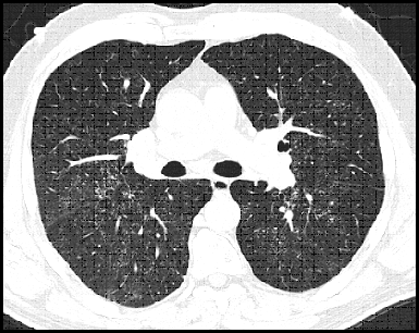 Diffuse fine nodular disease and adenopathy