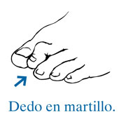 Ilustración de un pie con una flecha que señala hacia un dedo en martillo