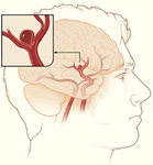 Ilustración de un aneurisma cerebral