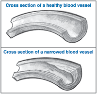 Two drawings: The top drawing is of a cross section of a healthy blood vessel. A label says “cross section of a healthy blood vessel.” The bottom drawing is of a cross section of a narrowed blood vessel. A label says “cross section of a narrowed blood vessel.”