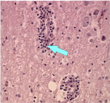 perivascular cuffing and inflamation around a blood vessel