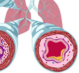 Illustration demonstrating the effect of NF-kB on airway remodeling.