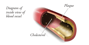 Diagram of the inside view of the blood vessel, showing spots of cholesterol and plaque building up on the vessel wall.