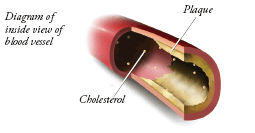 Diagram of the inside view of the blood vessel, showing spots of cholesterol and plaque building up on the vessel wall.