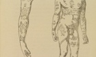 Two pen and ink drawings of tattoos - one a disembodied arm (belonging to a thief who was exiled from France) and the other the torso of a deserter from the French navy.