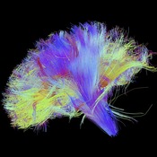 A diffusion spectral imaging (DSI) scan of the bundles of white matter nerve fibers in the brain. The fibers transmit nerve signals among brain regions and between the brain and the spinal cord.